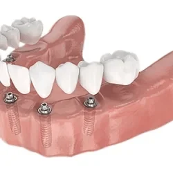 Tecnica all on 4 para reabilitacao oral