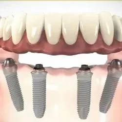 Carga imediata com implantes dentarios
