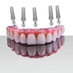 Protese protocolo sobre implantes